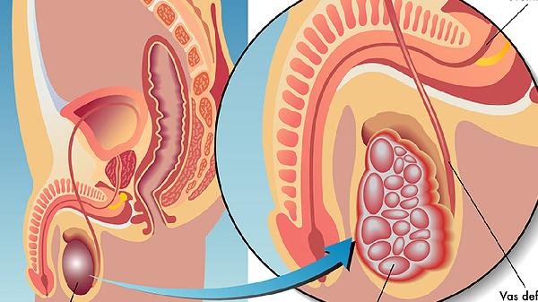 睪丸炎的危害是什么