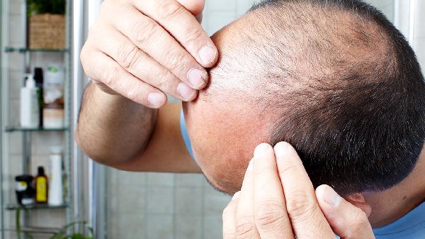 怎么治療脫發(fā)效果好