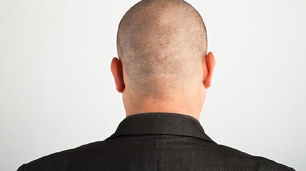 男人掉头发是正常的吗