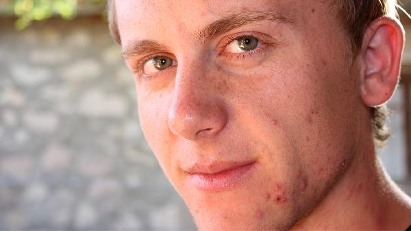 如何预防痤疮的伤痕