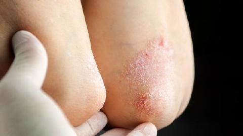 银屑病患者洗澡时的注意事项