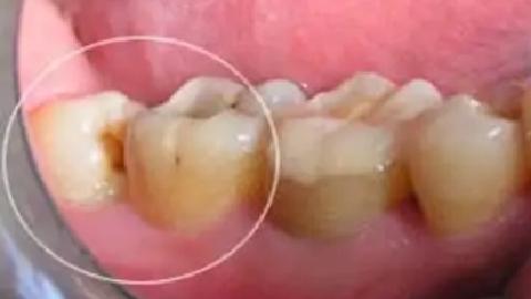 什么智齒需要拔除