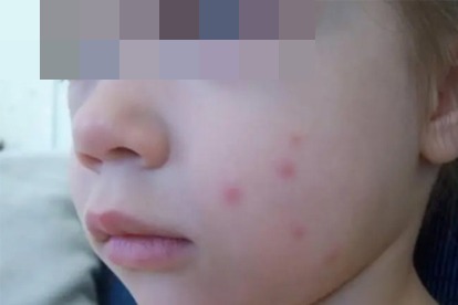 蚊子吸了乙肝病人的血，再咬另一個人，是否會傳染？答案出人意料