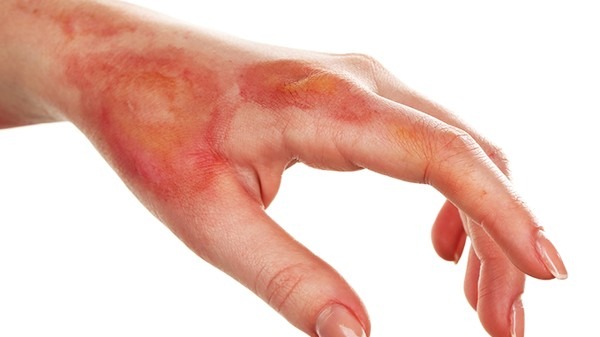 {烧伤后怎么判断感染了 烧伤伤口感染是什么样子}