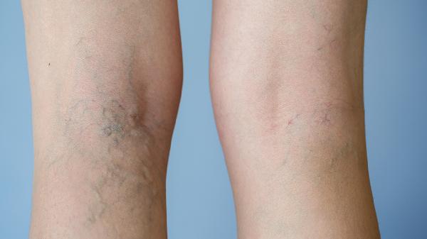 小腿經(jīng)常拉伸會(huì)讓小腿肌肉退散嗎