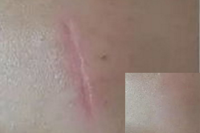 舒痕膠祛疤有效果嗎