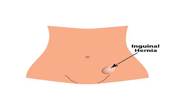 食管裂孔疝癥狀有什么