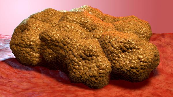 腎上腺腫瘤手術(shù)后后遺癥有哪些