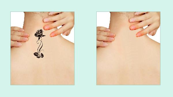 洗紋身皮秒和激光哪個好