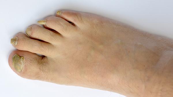 腳指甲上出現(xiàn)橫紋的幾種常見情況