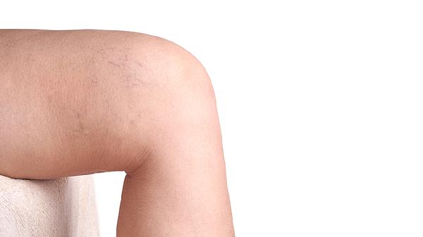 肩部滑膜炎的癥狀