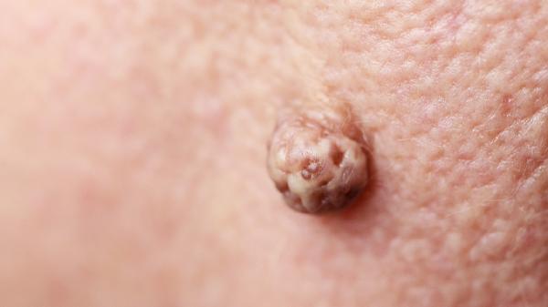 血管纖維瘤形成的原因有哪些