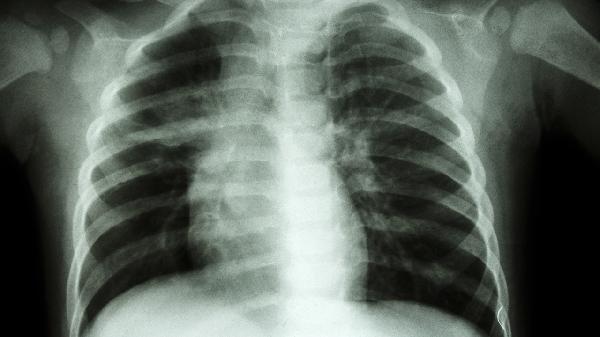 先天性胸廓畸形嚴重嗎