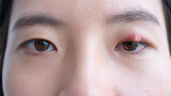 眼睛里長了麥粒腫怎么辦