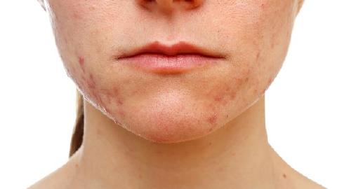 丹毒中醫(yī)治療效果好嗎