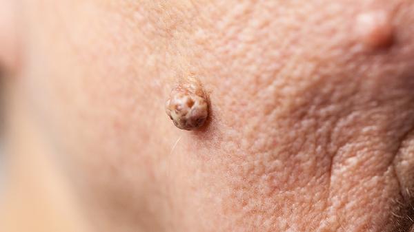 皮膚纖維瘤是什么病癥引起的