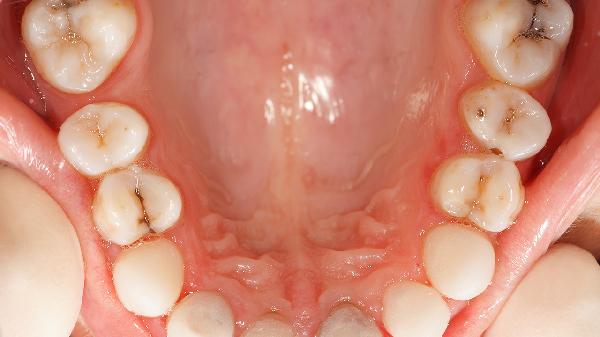 牙床子腫了如何消腫