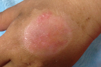 嘴巴被燙傷了怎么處理