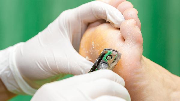 腳底長了好多雞眼怎么辦