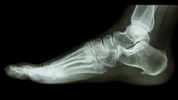 脚跟骨刺最佳治疗方法有哪些