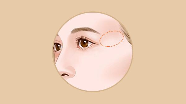 玻尿酸豐太陽穴怎么樣