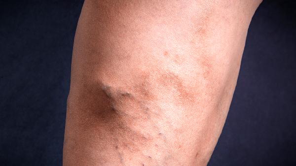 小腿一到白天就浮腫怎么回事