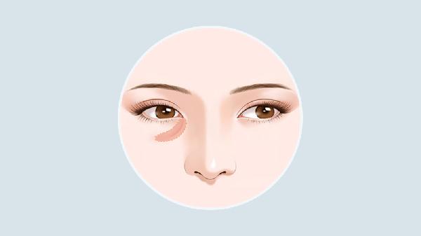 自體脂肪豐淚溝效果能保持多久