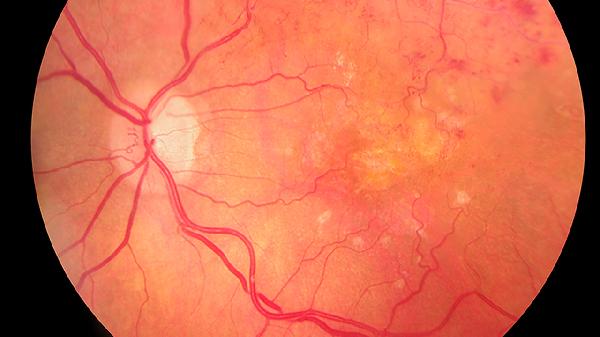 颅内外血管搭桥手术方法有哪些