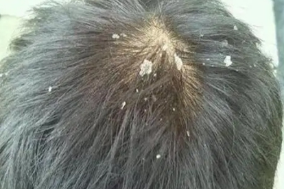 7歲女孩有頭皮屑怎么回事