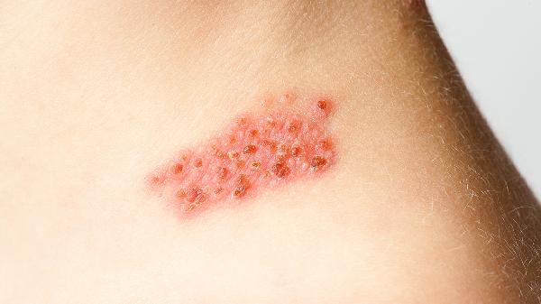 玻尿酸對皮膚的作用與功效