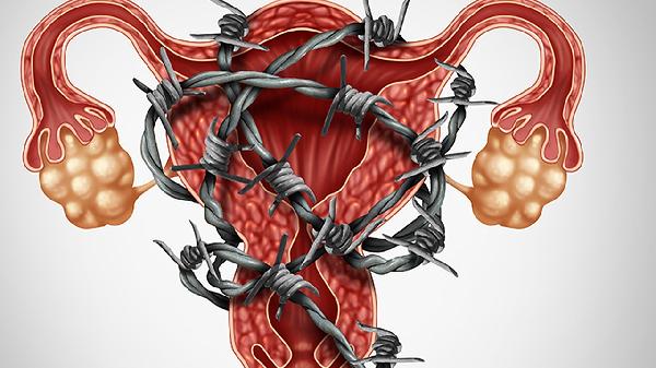 十幾歲女孩卵巢囊腫怎么治療