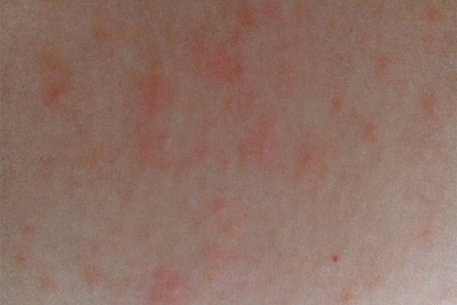 噴酒精過(guò)敏怎么辦