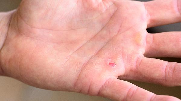 腳長水泡怎么處理