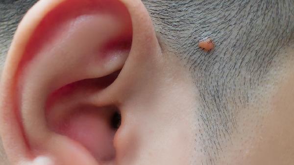 骨化纖維瘤需不需要手術(shù)