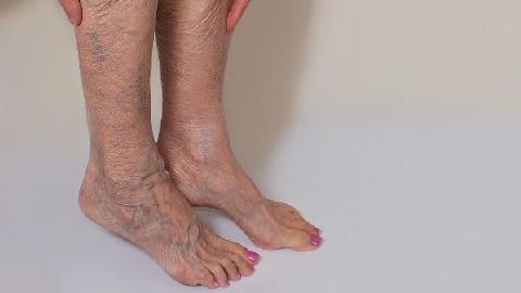 全身浮腫掛什么科