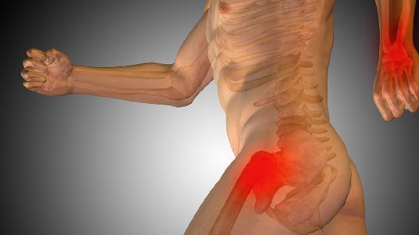 先天性股骨頭發(fā)育不良的癥狀