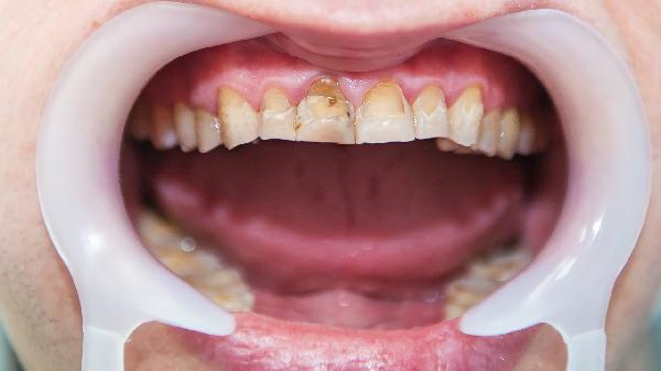 牙齦疼會(huì)引起腮下淋巴腫大和疼痛嗎