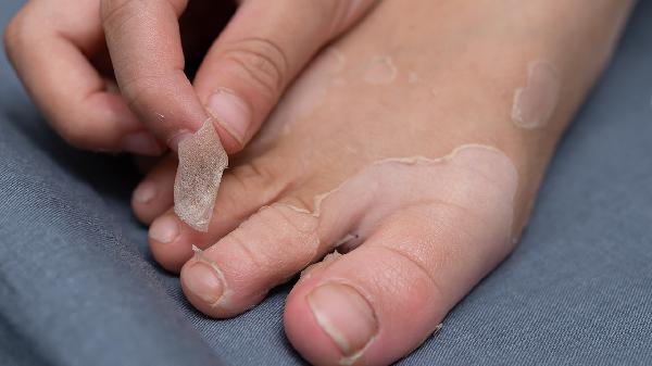 皮膚干燥如何補水最快