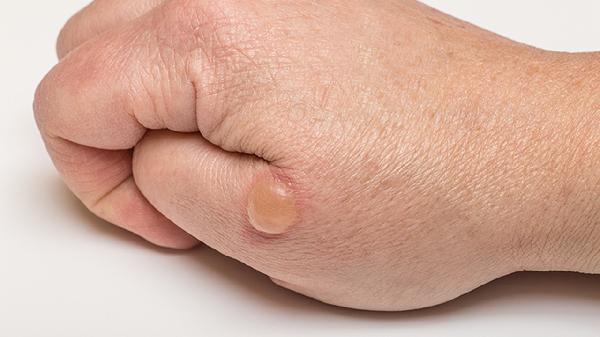 唇上起水泡是怎么回事