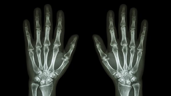 右手中指關(guān)節(jié)腫大怎么辦