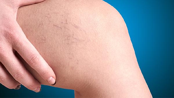 滑膜肉瘤復(fù)發(fā)可以二次手術(shù)嗎