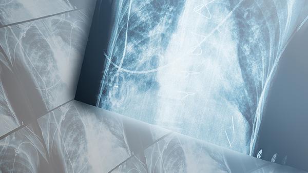 肺炎有糖尿病应该吃点儿什么东西