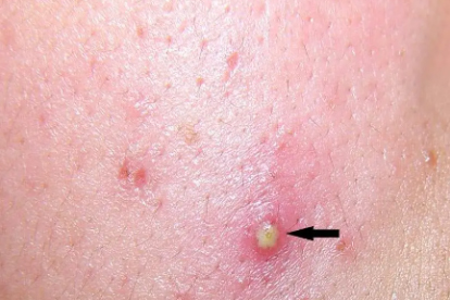 細菌性毛囊炎癥狀