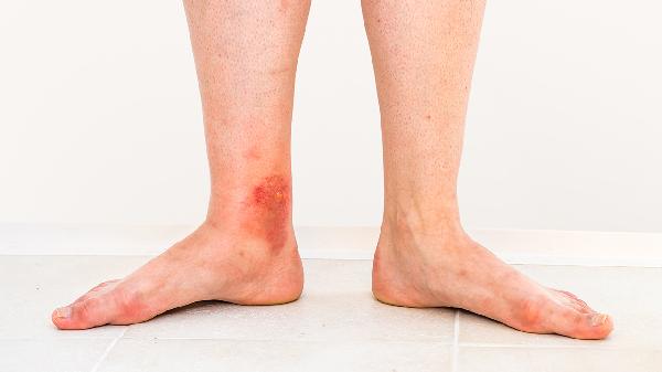 蠟燭滴到身上會不會留疤呢