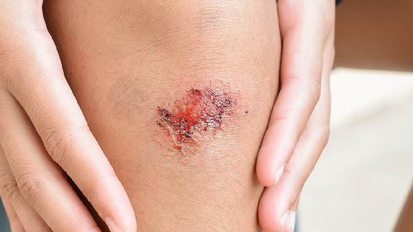 腳大拇指凍傷紅腫疼痛怎么辦