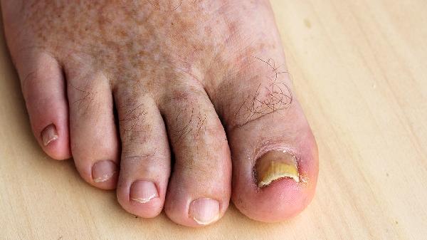 嵌甲的中医治疗方法