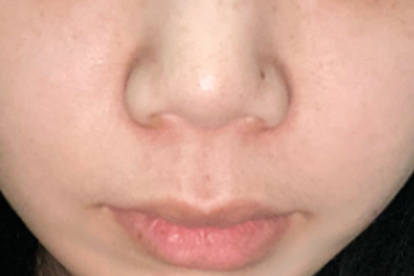 寶寶嗆奶后鼻子呼嚕呼嚕