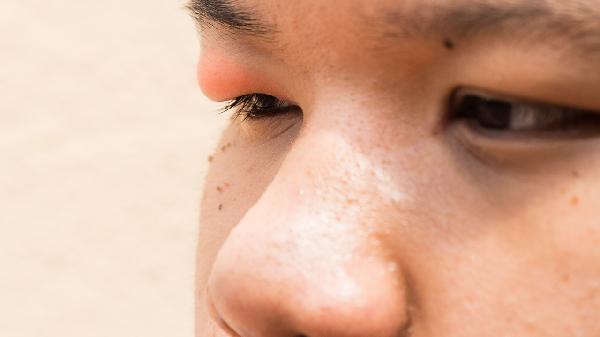 眼睛整形開眼角多少錢