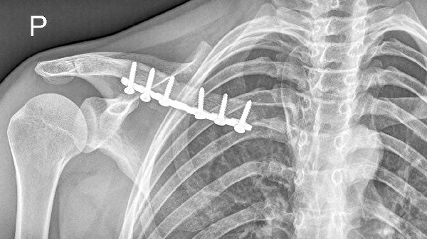 锁骨为什么会骨折