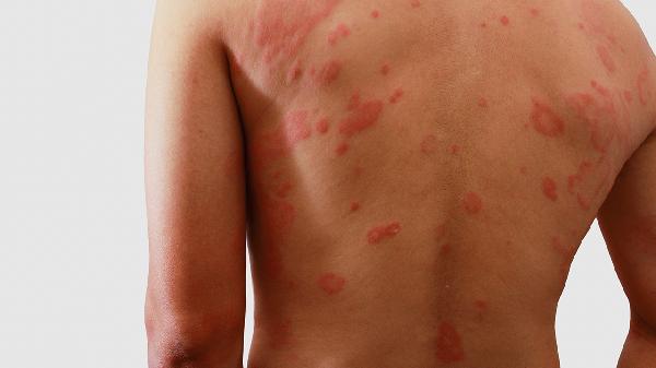 梅毒男性癥狀是什么